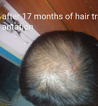Resolved] Glamdoc Looks Studio (Hair Transplant) Vashi Navi Mumbai And  Hyderabad — incorrect and bad hair transplant