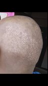 misleading people, unethical, given me complications after hair transplant surgery