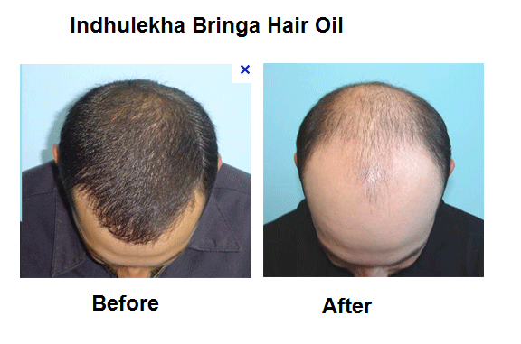 Resolved] Indulekha Bringha Hair Oil — Review of Indulekha Hair oil -  Please dont buy